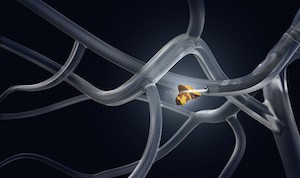 robotic assisted bronchoscopy
