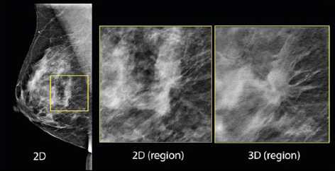 3D-mammography 3D-mammography